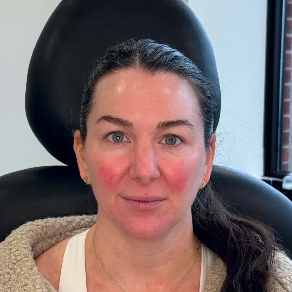 Female client after Neurotoxin treatment at Morph Med Spa in Ridgefield, CT – smoother forehead, brow, and eye-area appearance