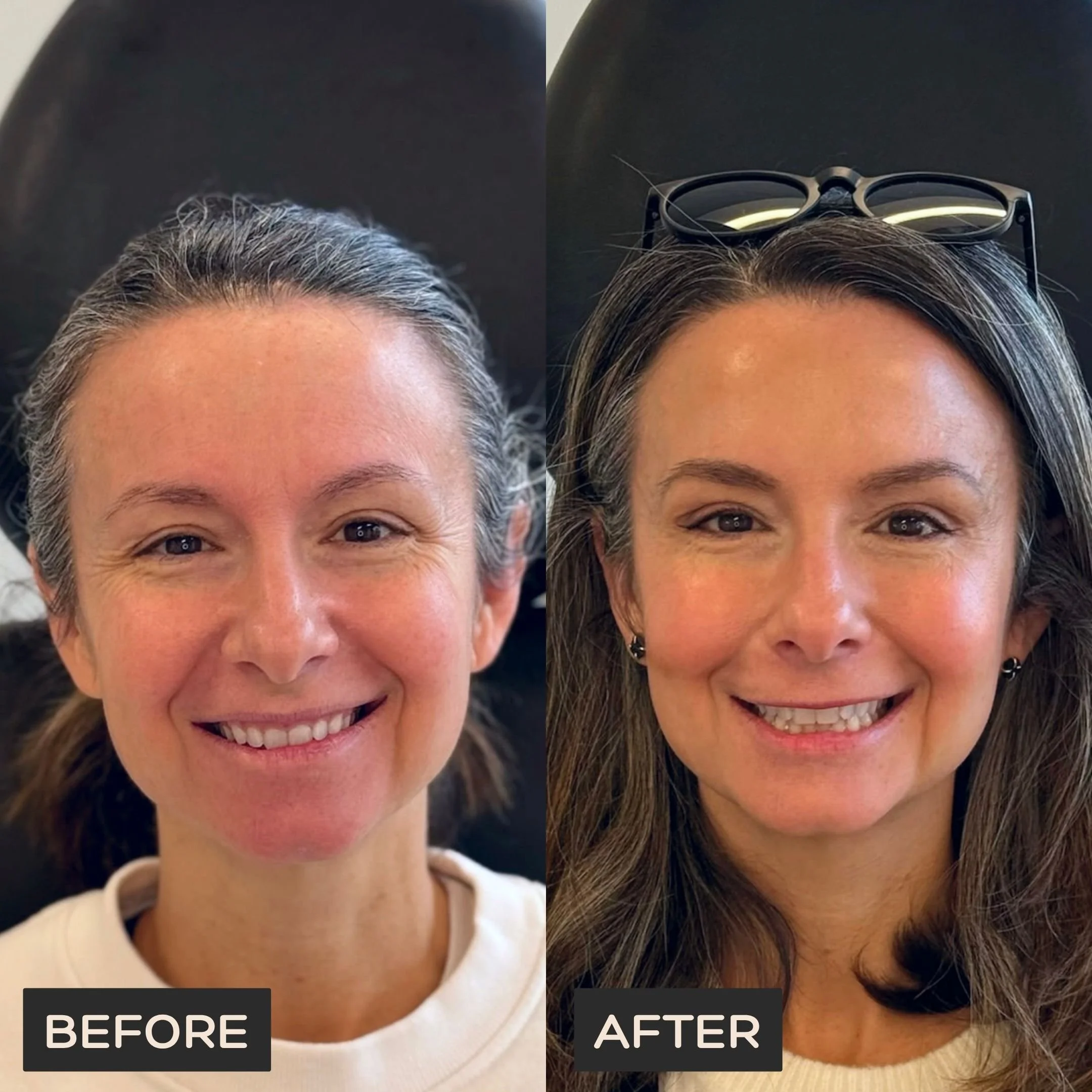 Female client before Neurotoxin treatment at Morph Med Spa in Ridgefield, CT — visible forehead and brow lines