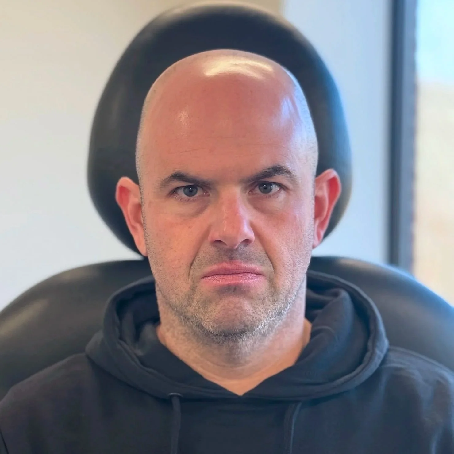 Male client before Radiesse and Neurotoxin treatment at Morph Med Spa in Ridgefield, CT — visible volume loss in midface and forehead lines