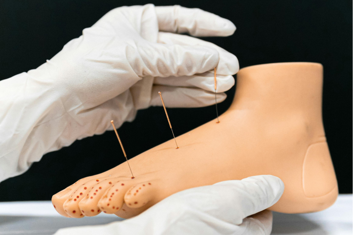 Acupuncture for CRPS at Mountain View Pain Center