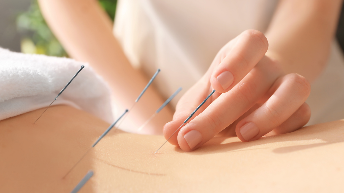 Acupuncture at Mountain View Pain Center for Sciatica Nerve Pain
