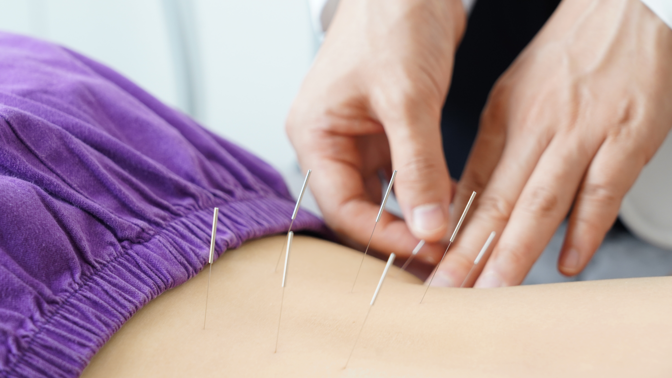 Acupuncture at Mountain View Pain Center for Radiculopathy