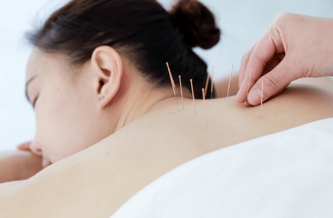 Acupuncture treatment at a Mountain View Pain Center clinic
