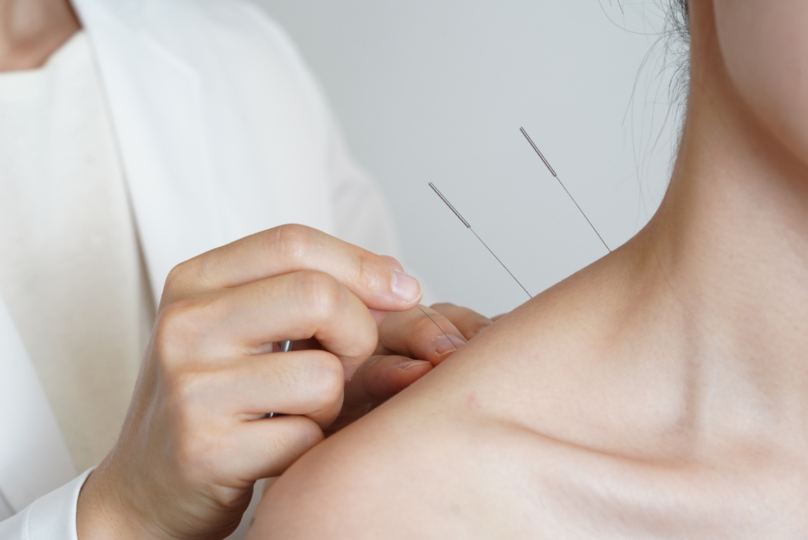Acupuncture at Mountain View Pain Center for Numbness and Tingling