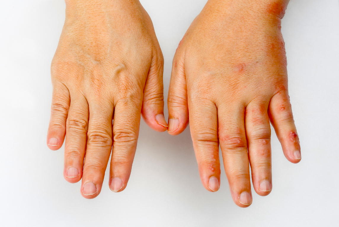 CRPS Treatment at Mountain View Pain Center