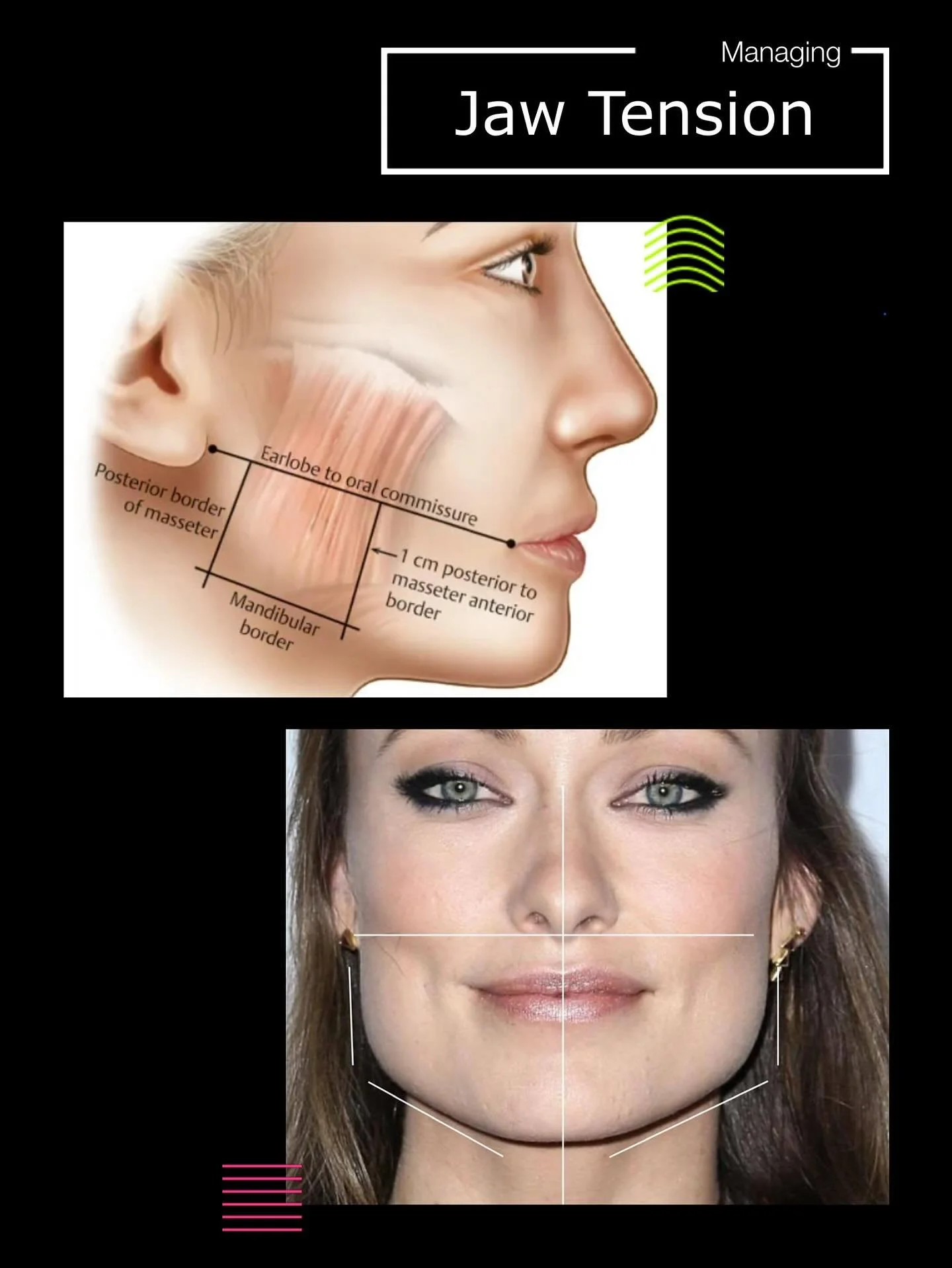 For some people, jaw tension is more than just a nuisance - it can impact everyday life. One of our clients shared that she had struggled with severe jaw tightness for as long as she could remember. The muscles were so overactive that even biting int