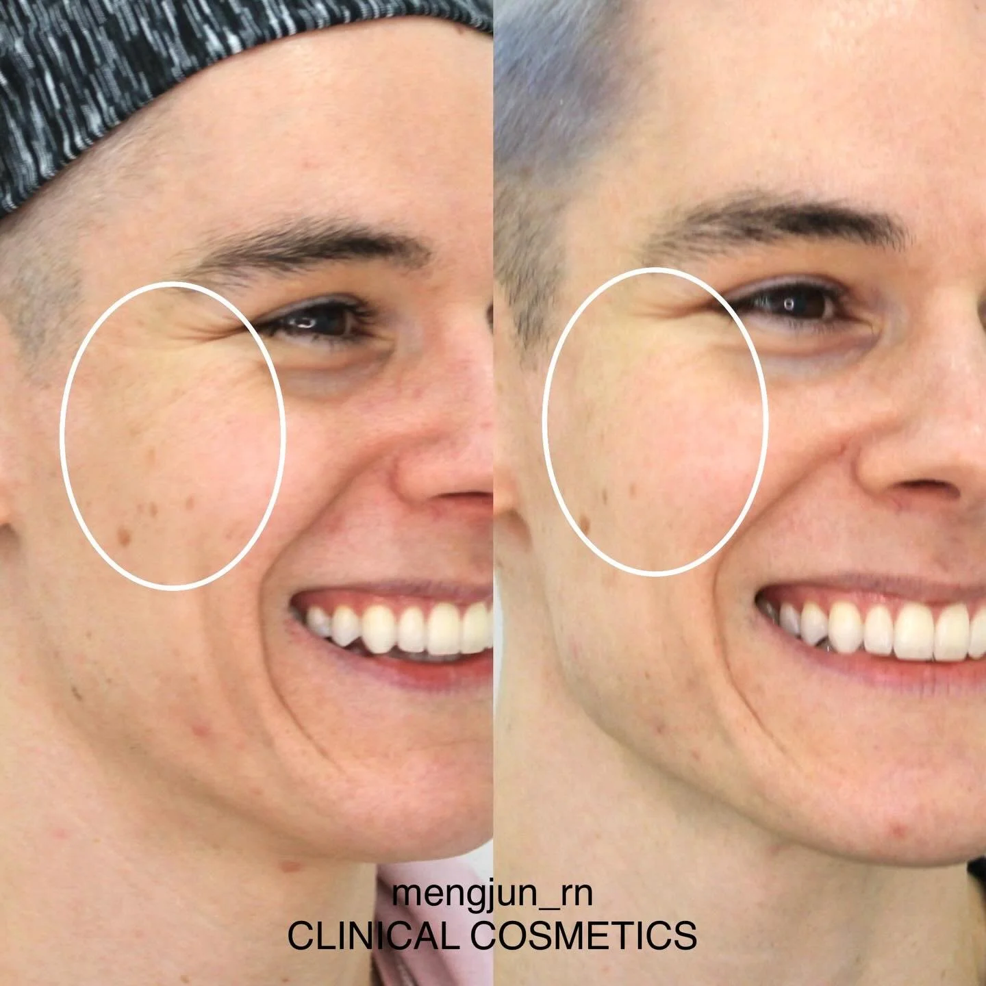 With the rapid advancements in cosmetic medicine, we now have more treatment options than ever before.

When our clients return for follow-up appointments, we carefully reassess their skin and sometimes recommend a different approach - even something