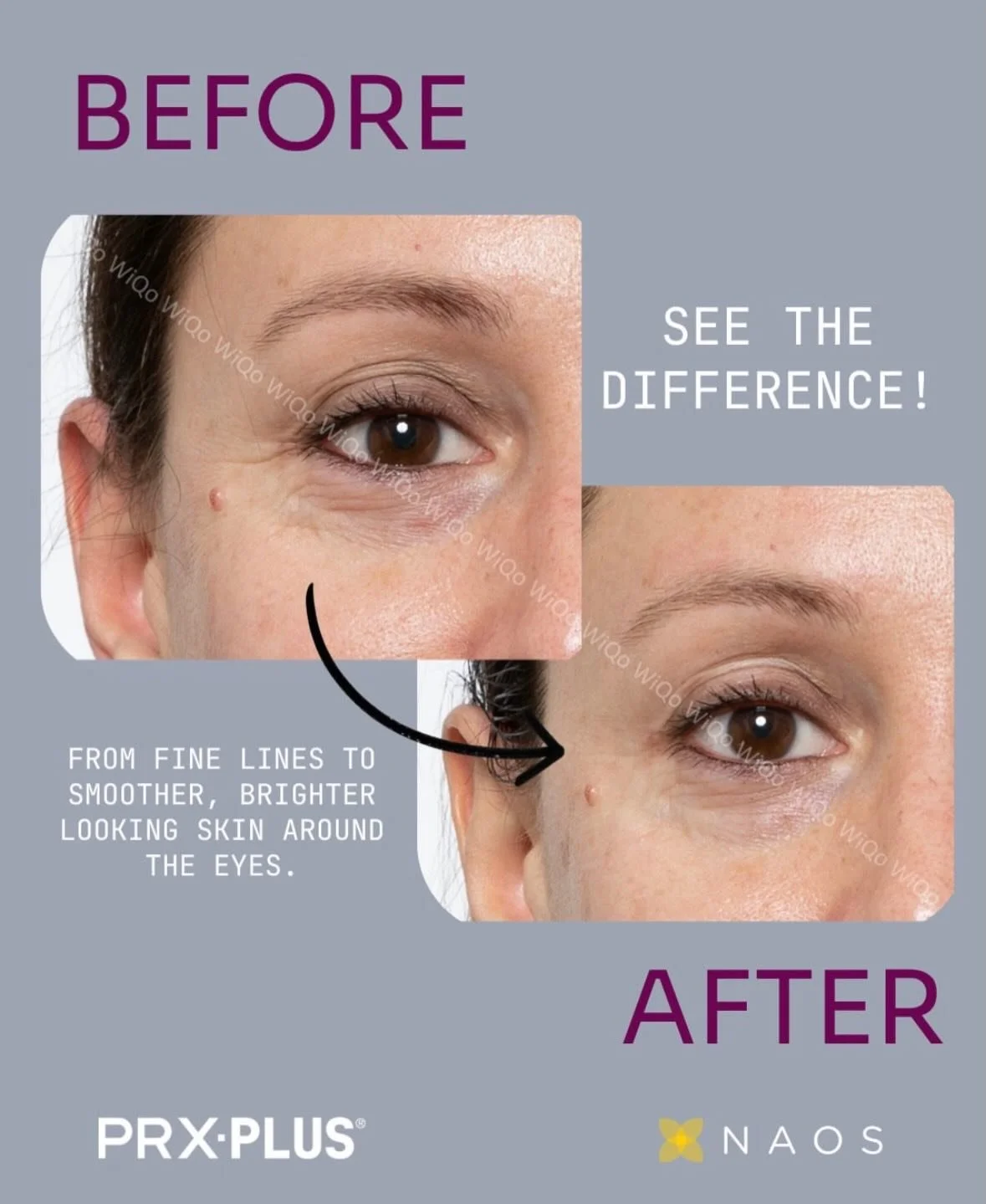 You don&rsquo;t need downtime to improve your skin.

PRX Plus is a needle-free biorevitalisation treatment designed to support brighter, firmer, and healthier-looking skin through controlled skin renewal, with minimal disruption to your daily routine