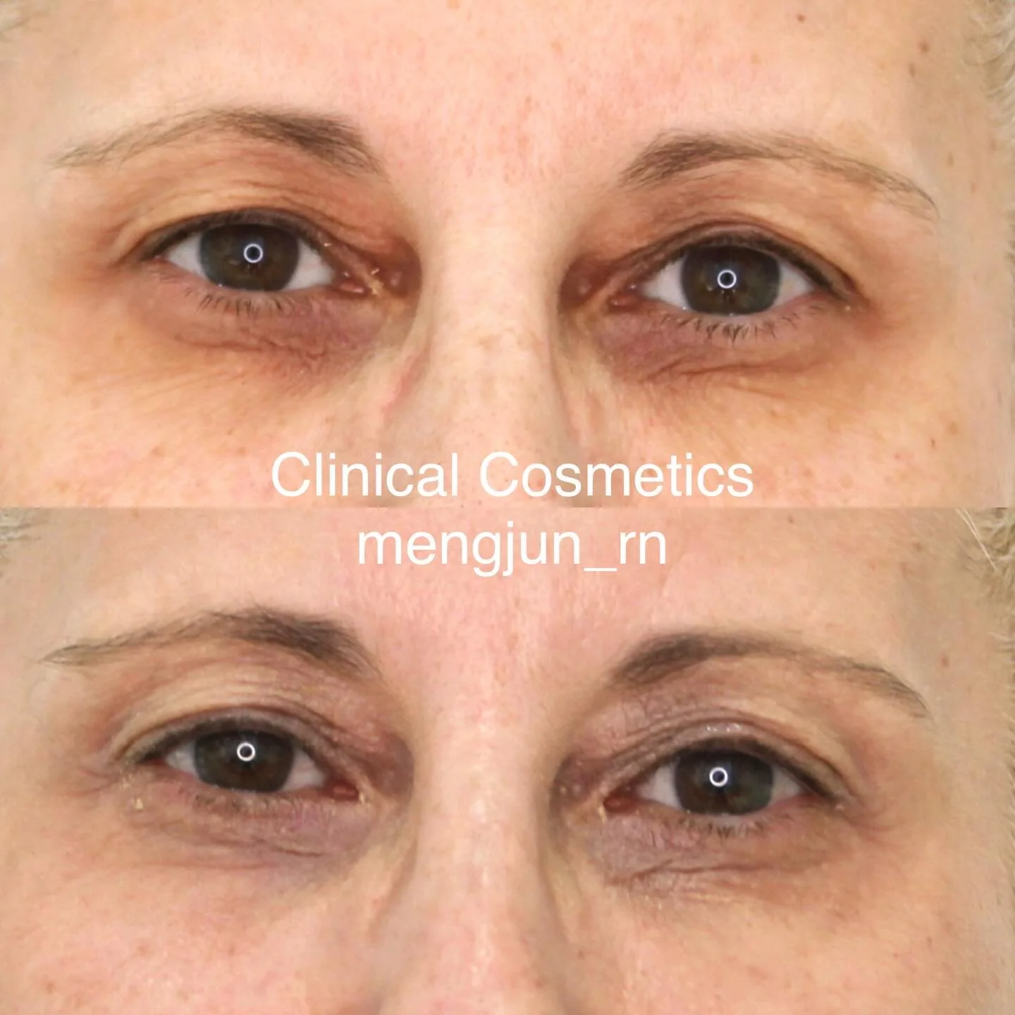 Eyelid tightening: TIXEL is a safe and effective treatment for tightening delicate eyelid skin.

How does TIXEL work?

TIXEL uses a patented fractional titanium tip, heated to 400&deg;C, which makes brief, precise contact with the skin. This delivers
