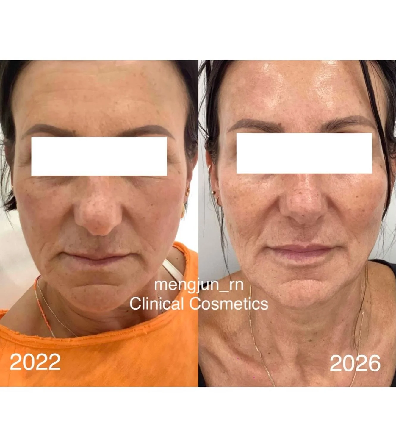 What a thoughtful, consistent patient&ndash;practitioner partnership can achieve over time.

These before and after images reflect a four-year journey focused on gentle rejuvenation and long-term skin regeneration. Rather than chasing quick fixes, we
