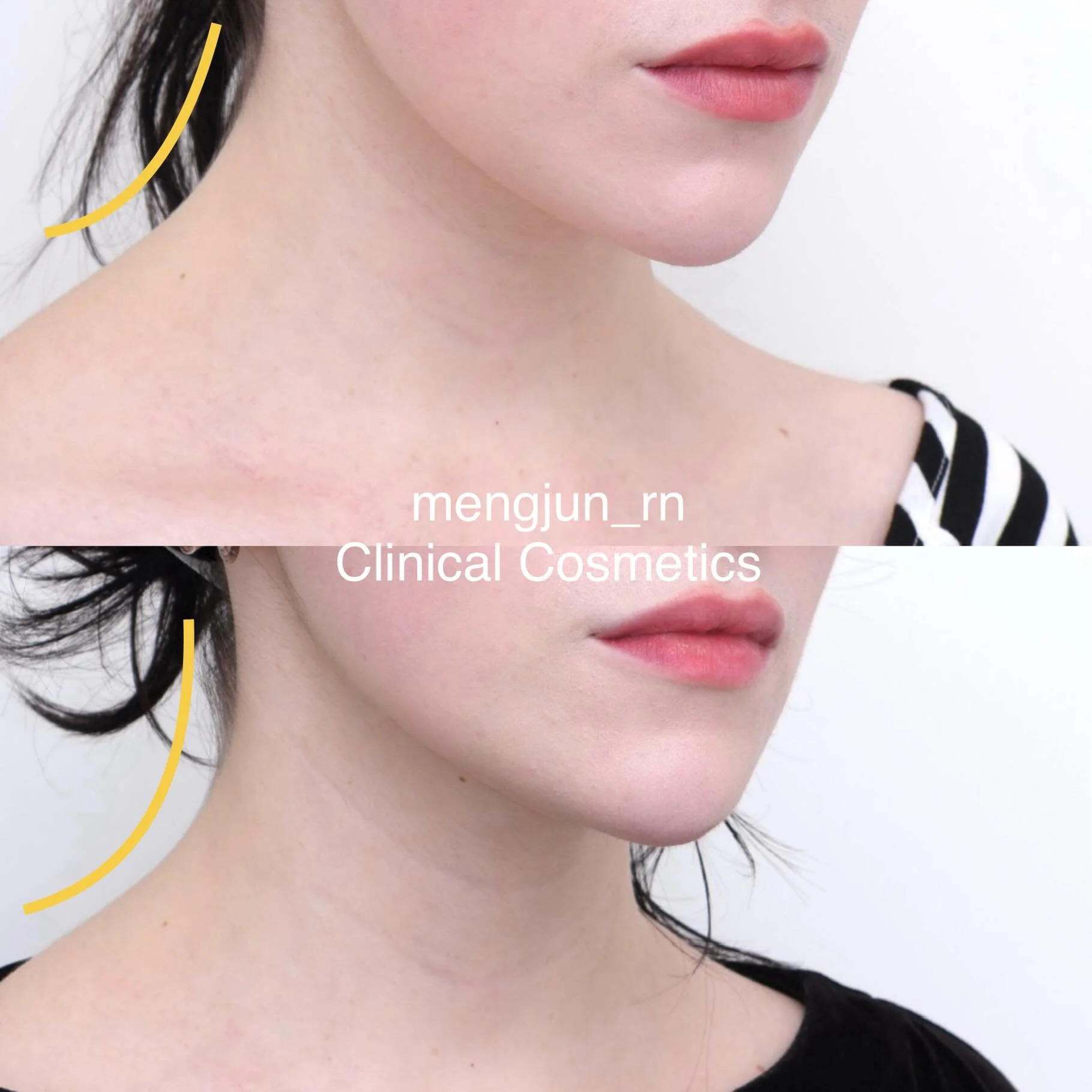 Did you know that we also treat shoulder tension?

Chronic tension through the shoulders and neck can contribute to discomfort, tightness, and changes in posture over time. By helping to relax overactive muscles, we can often see a noticeable improve