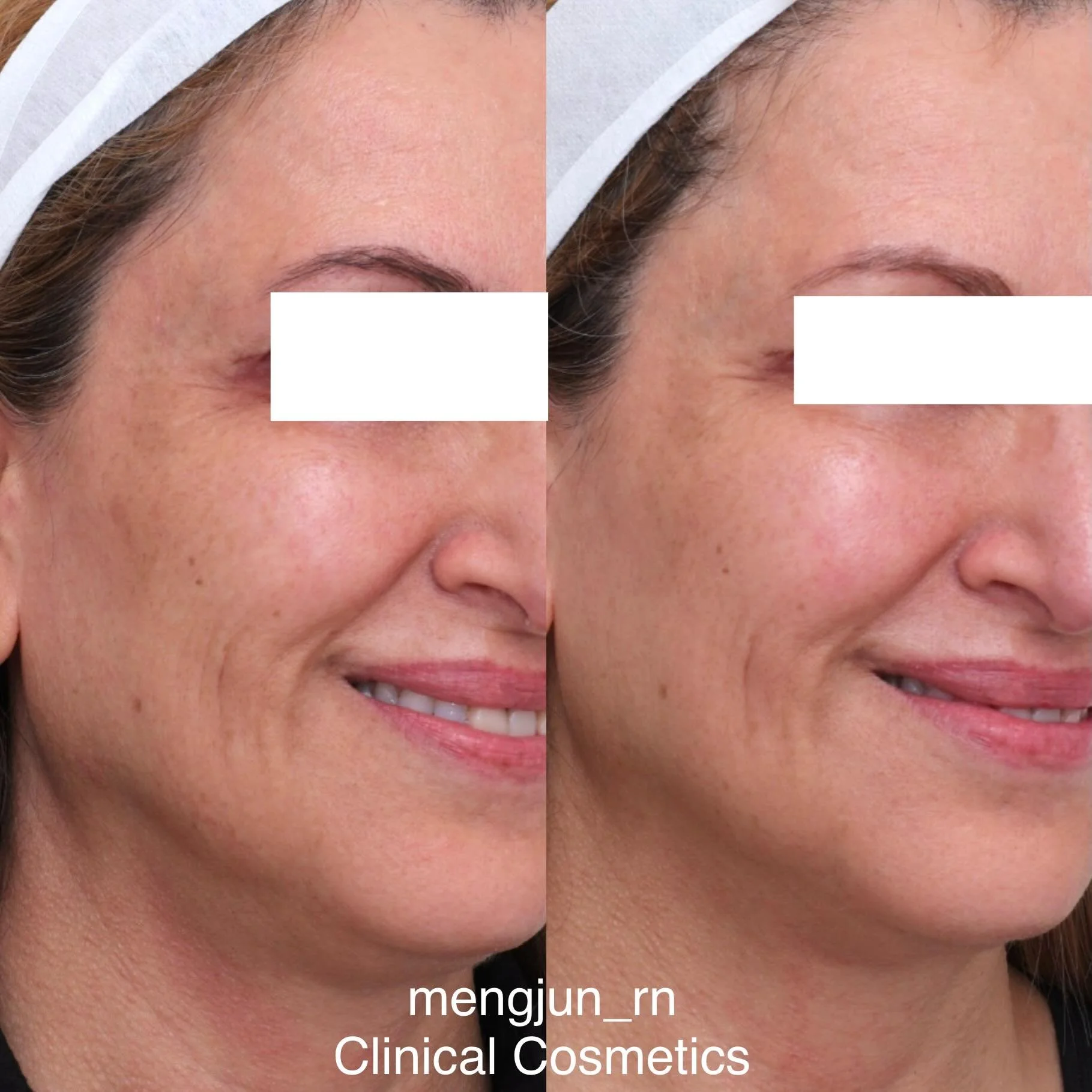 Four weeks apart.

We have been so pleased to see these beautiful skin improvements from our new treatment, PRX Plus - achieved with meticulous application, no discomfort, and no social downtime.

What we are noticing:
&bull; brighter, more radiant s