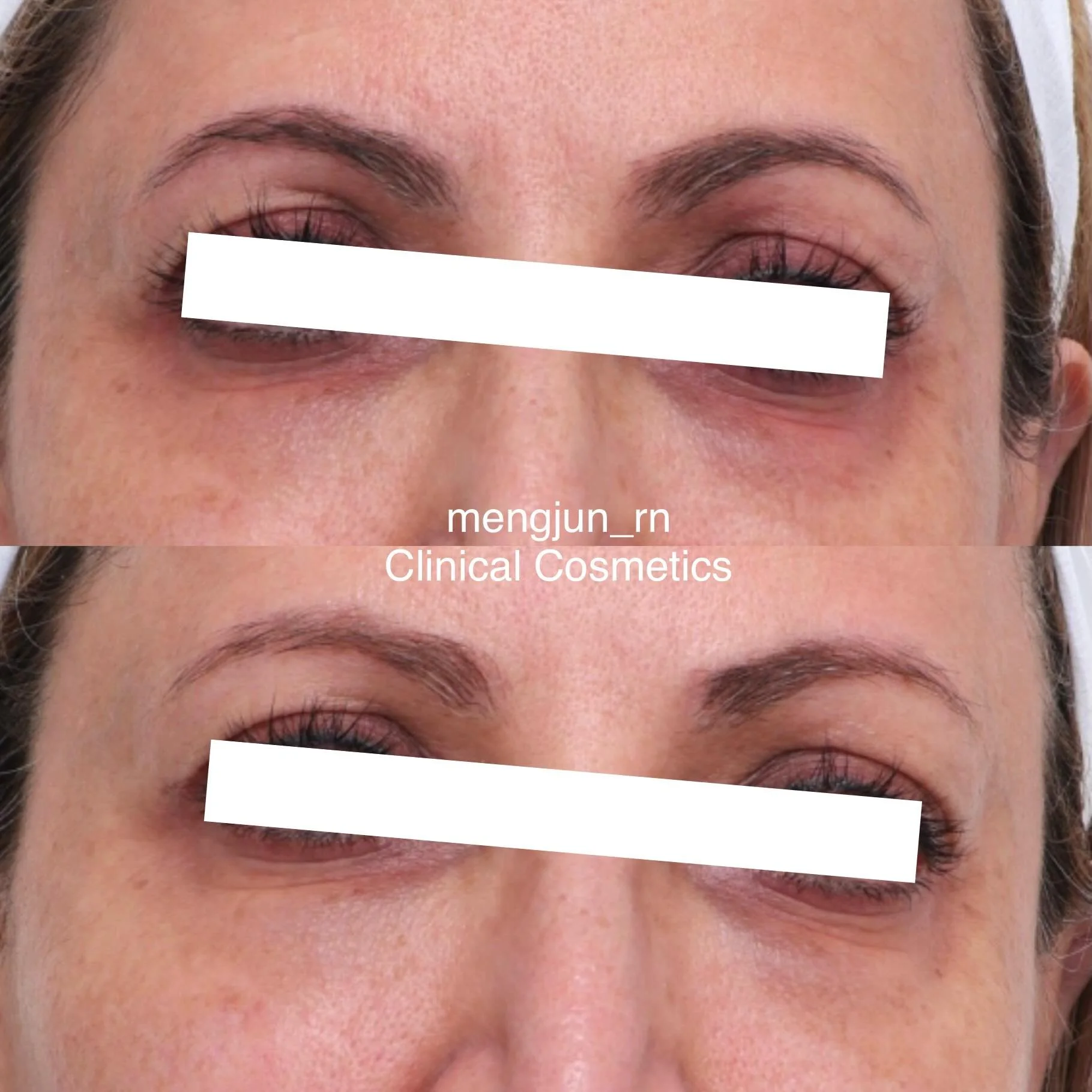 PRX Plus after 2 sessions by MJ.

Swipe left to see the vascular-filter images showing visible improvement in facial redness, skin clarity, and the delicate under-eye area after just 2 treatments.

You may notice:
&bull; Reduced redness and blotchine