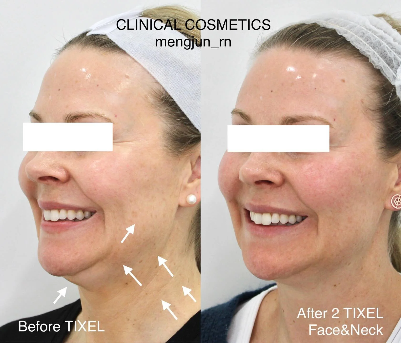 After 2 sessions of TIXEL Skin Tightening treatments to the face and neck, our client experienced visible improvements in:

&bull; Skin tone and texture
&bull; Overall skin firmness, particularly around the eyelids, jawline, and under the chin
&bull;
