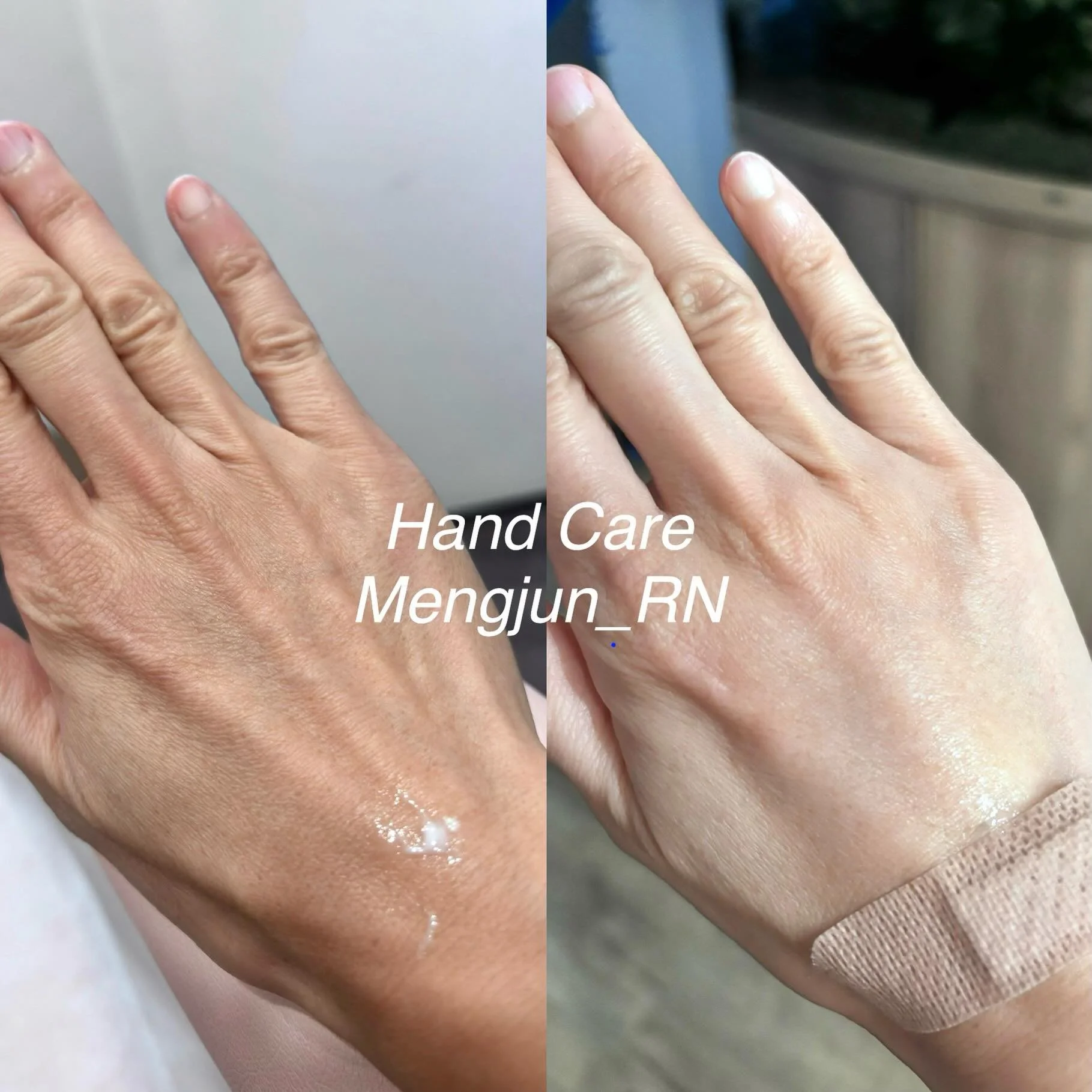 A little self-care today 💛

A huge thank-you to my wonderful friend Olivia @olivia_originaesthetics for treating my hands today.

After many years of injecting, I&rsquo;ve noticed some mild arthritis symptoms in my thumb. The treatment is designed t