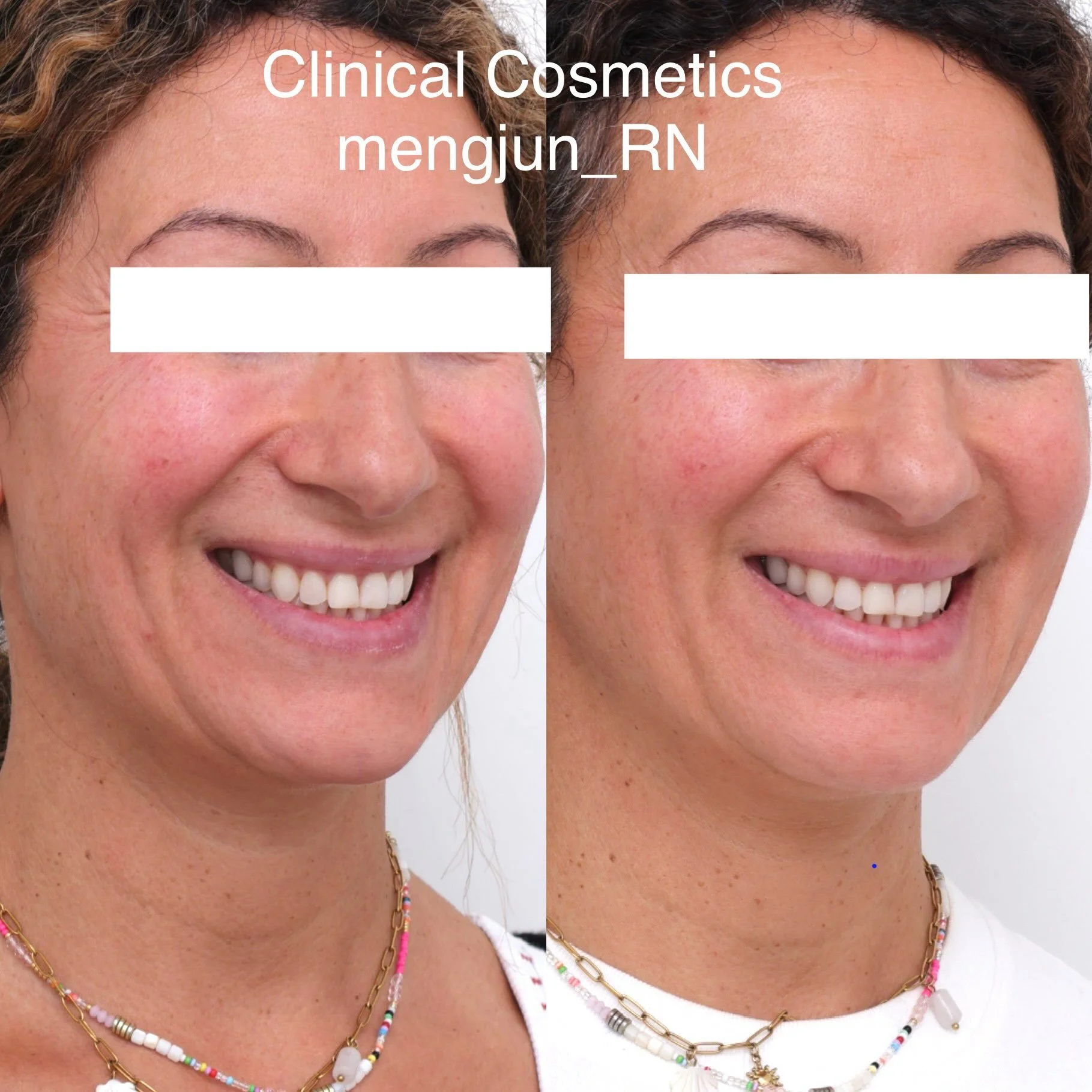 Rather than simply adding volume or changing the surface, bio-regenerative treatments are designed to support the skin&rsquo;s natural regenerative processes, helping improve overall skin quality and the health of the underlying tissues over time.

I