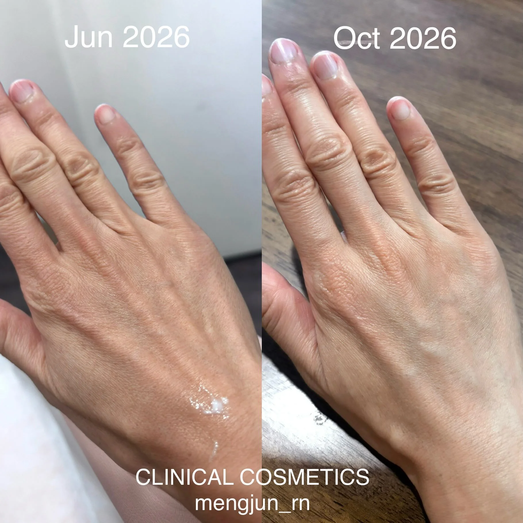 This before-and-after shows a hand 3 months following a bio-regenerative treatment.

Rather than focusing simply on adding volume, this approach is designed to support the quality and appearance of the skin and underlying tissue over time.

And impor