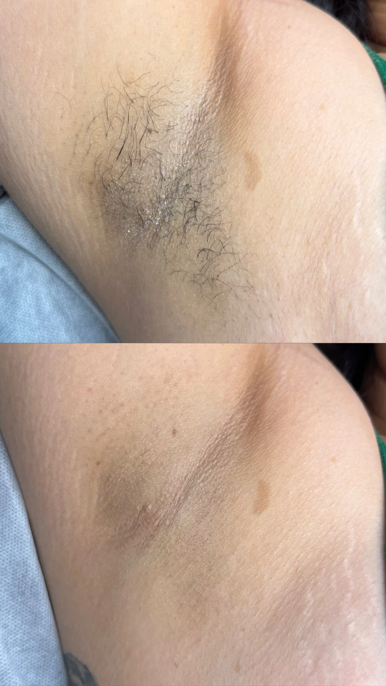 Before and after image of an armpit, showing hair removal. The top shows an armpit with hair, and the bottom shows a smooth, hair-free armpit.