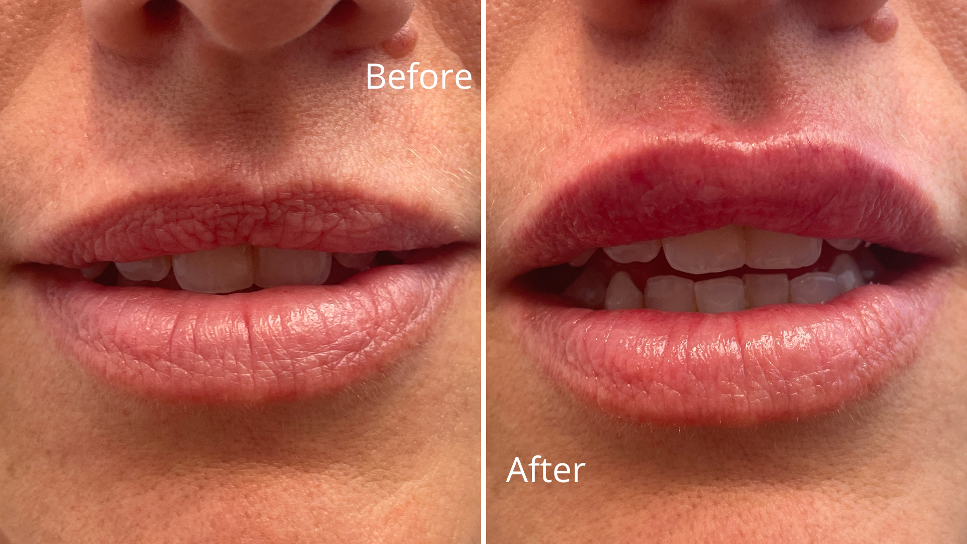 Lips_em_Injectables BeforeAfter.png