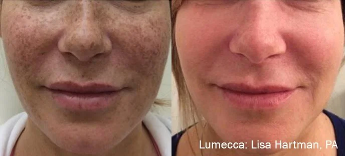 LH_2a_1tx_Freckles (1).jpg