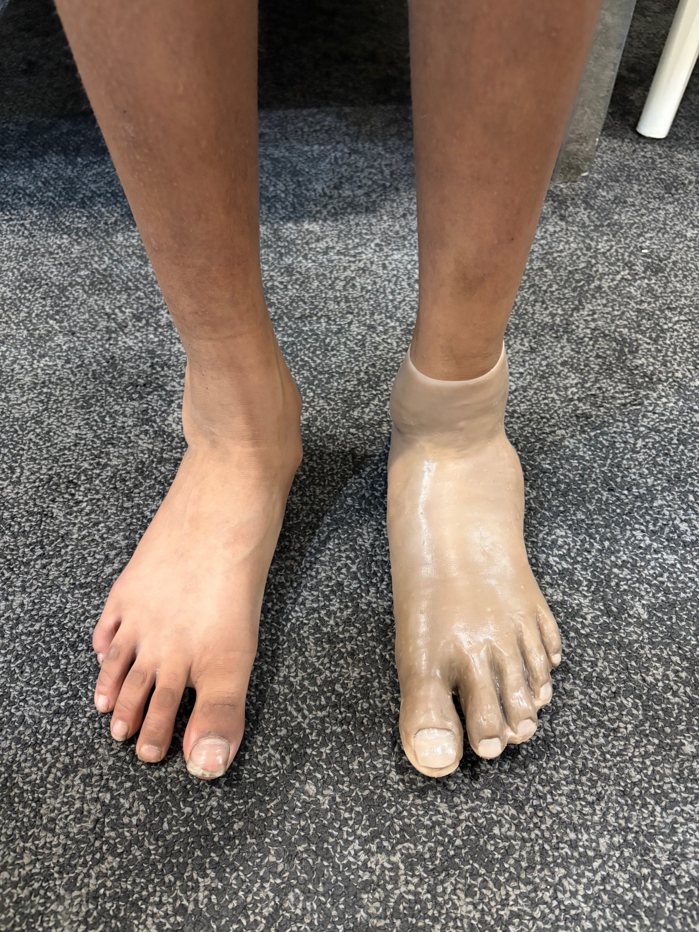 In-house Silicone Partial Foot Prostheses