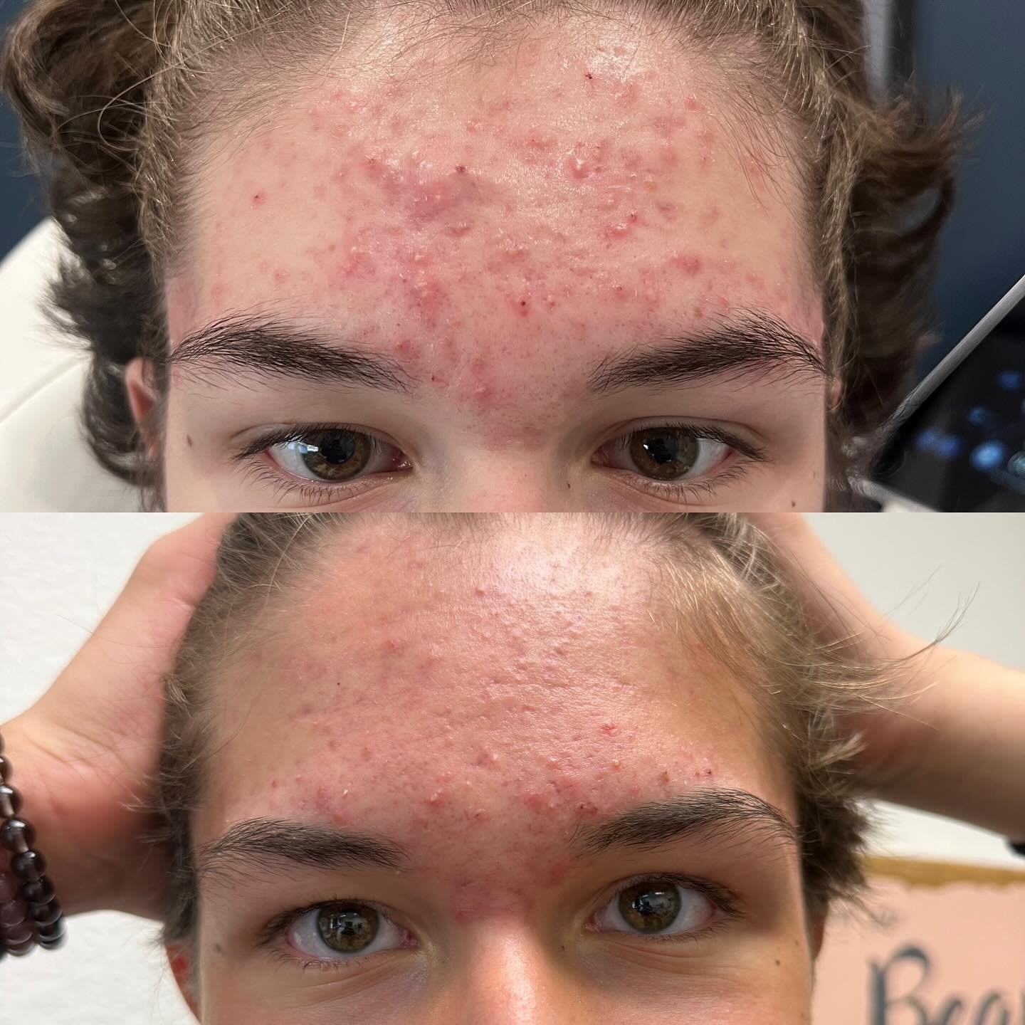 🌟 The Importance of Adolescent Skin Care 🌟

Teen skin is constantly changing and often faces challenges like excess oil, clogged pores, and stubborn acne. Early, proper skincare is crucial&mdash;not just for clear skin today, but for healthy, confi