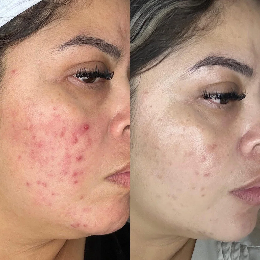 Korean Clarity Peel (6 months apart)