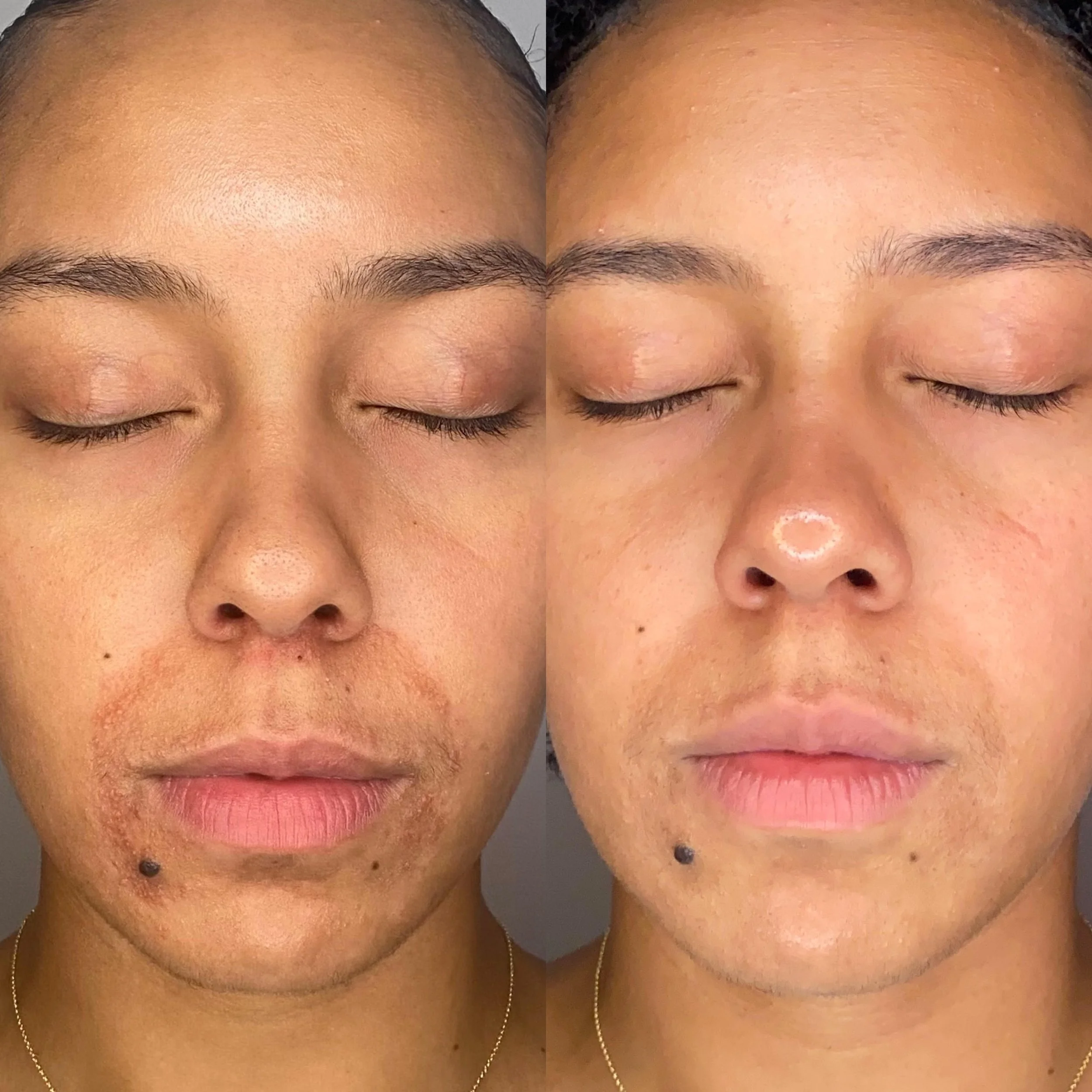 Case Study Program (2 months apart, 2 Txs)
