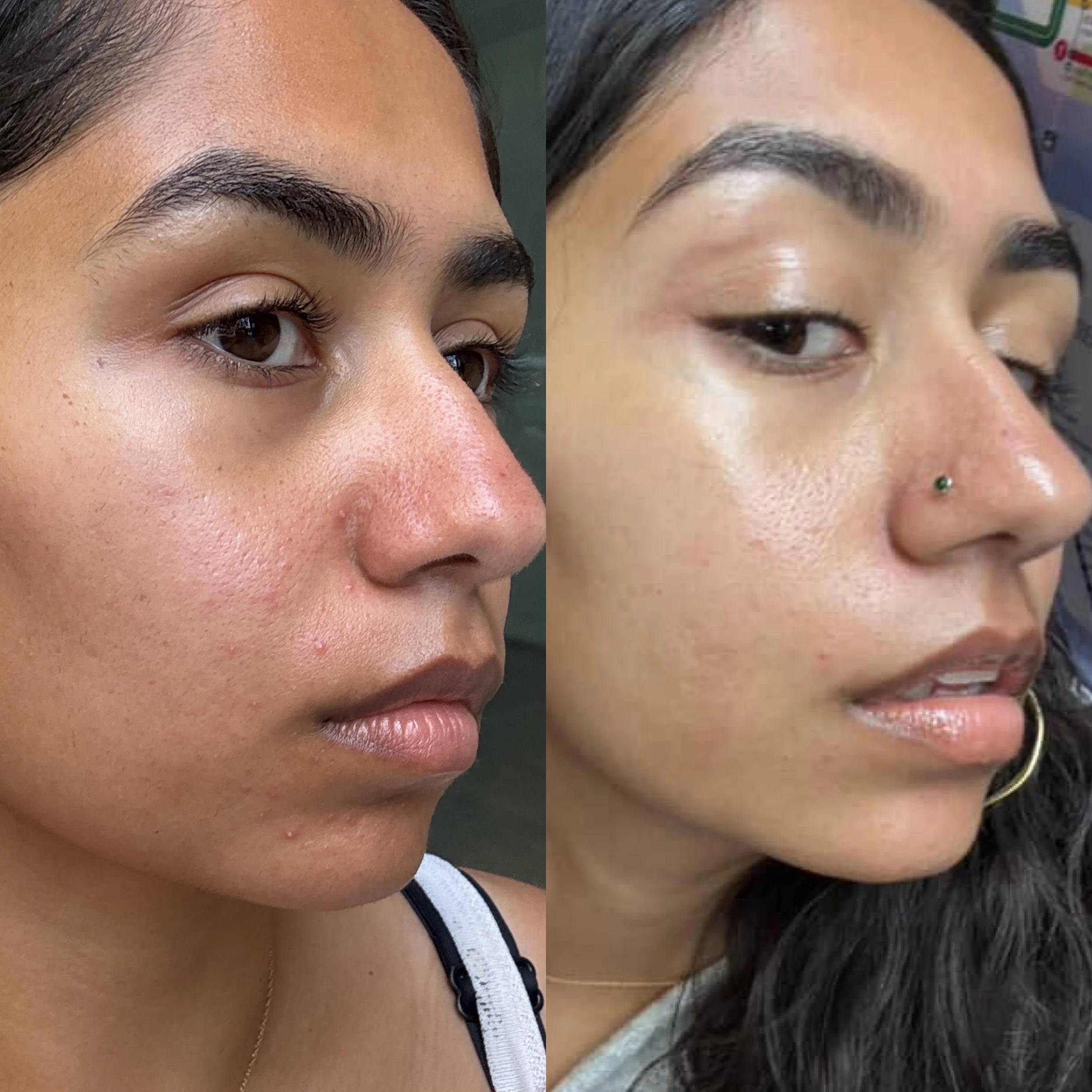 Botanical Healing Treatment + SIV (4 days apart, 1 Tx)