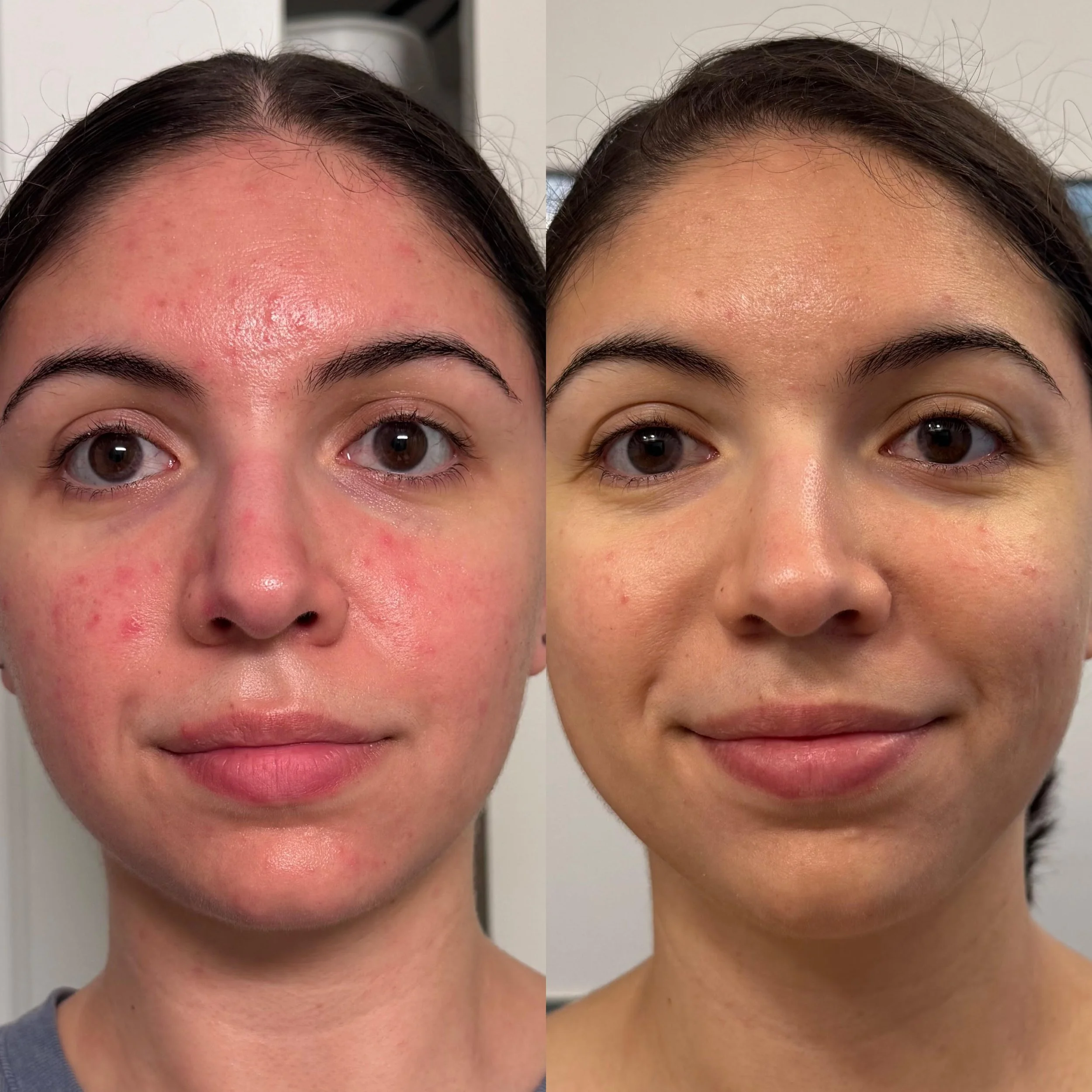 Botanical Healing Treatment + SIV (3 days apart, 1 txs)