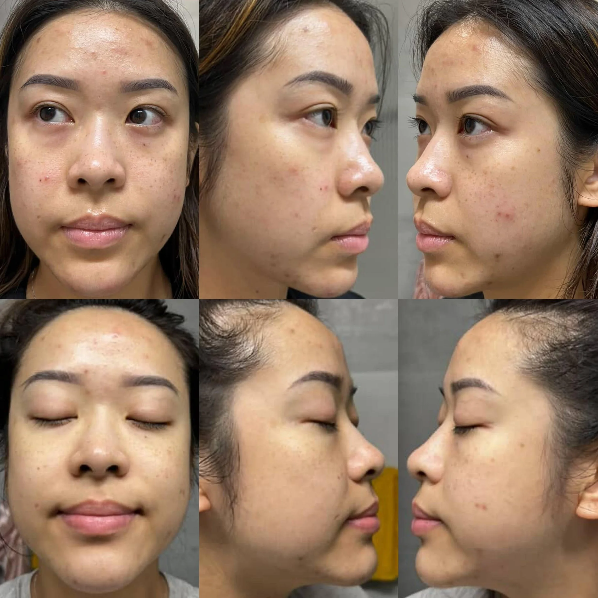 Korean Clarity Peel (60 minutes apart, 1 Tx)