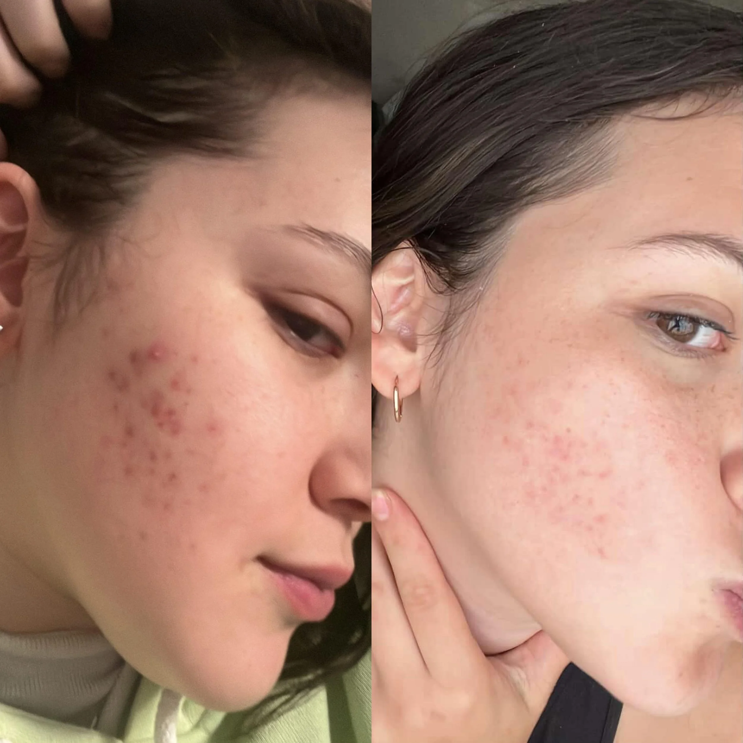 Virtual Acne Management Consultation + SIV (5 months apart, No Txs)