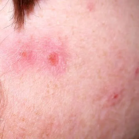 EXOSOME-BASED THERAPY