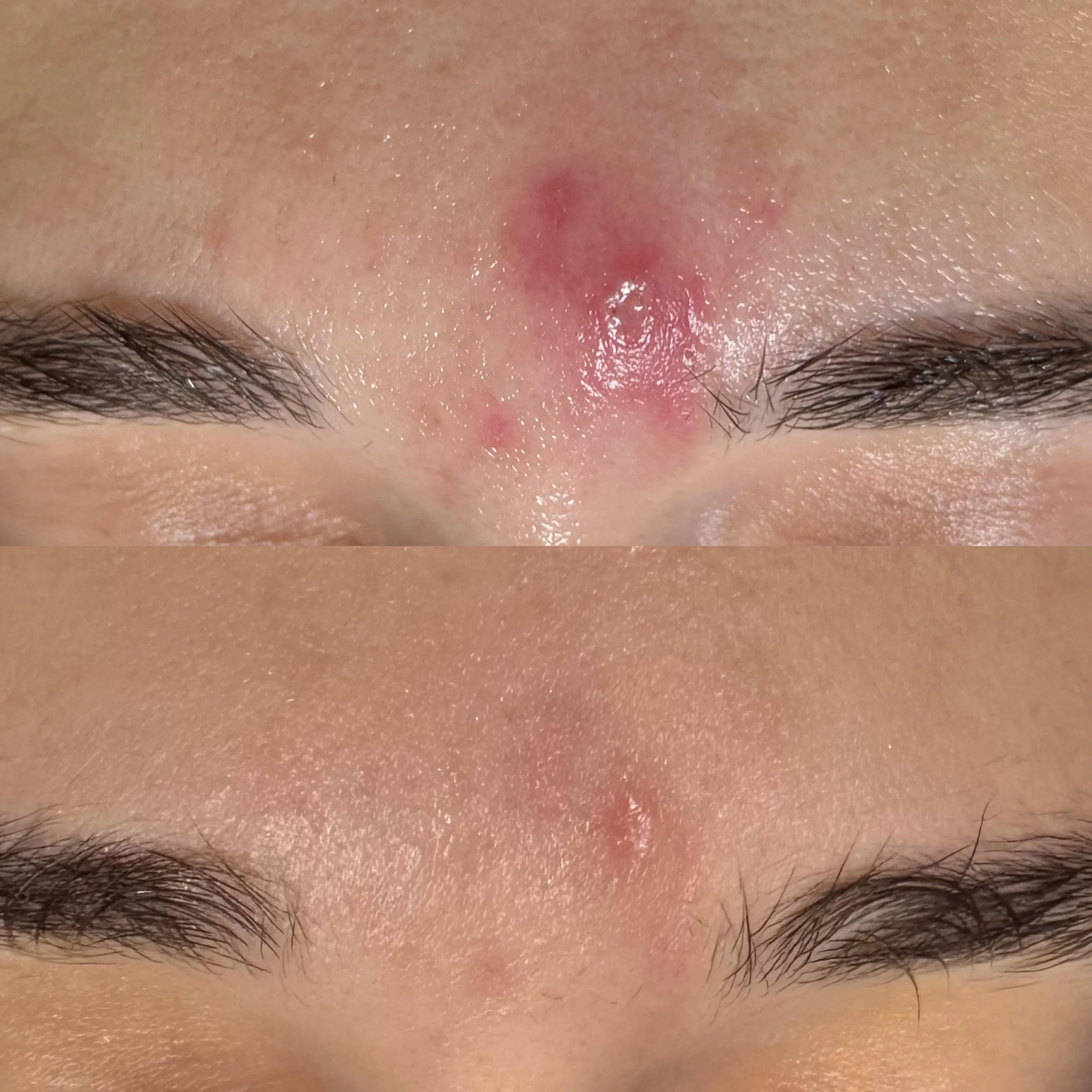 marissa shandell forehead 3 weeks, 4 treatments (no logo).jpg