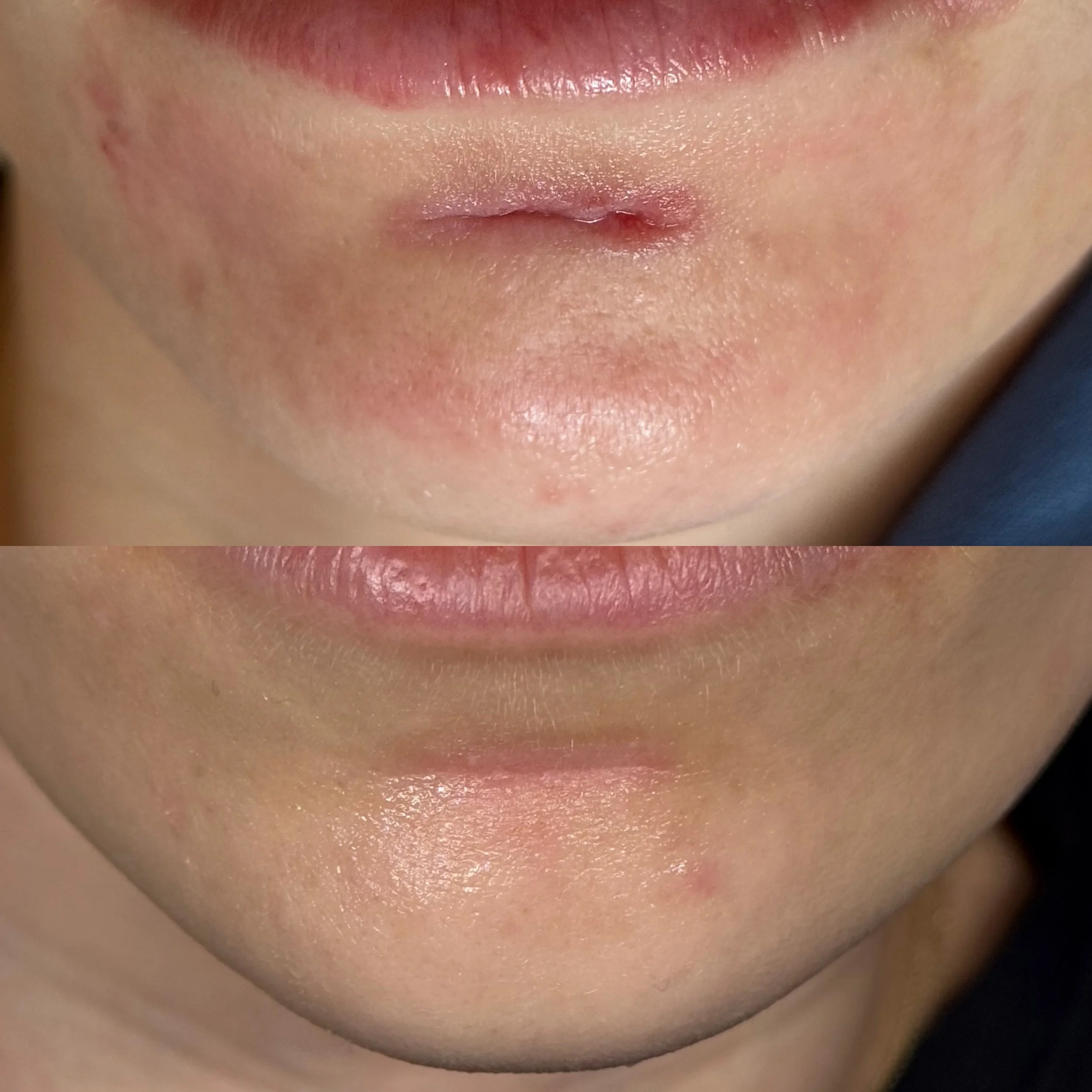 compulsive skin picking disorder