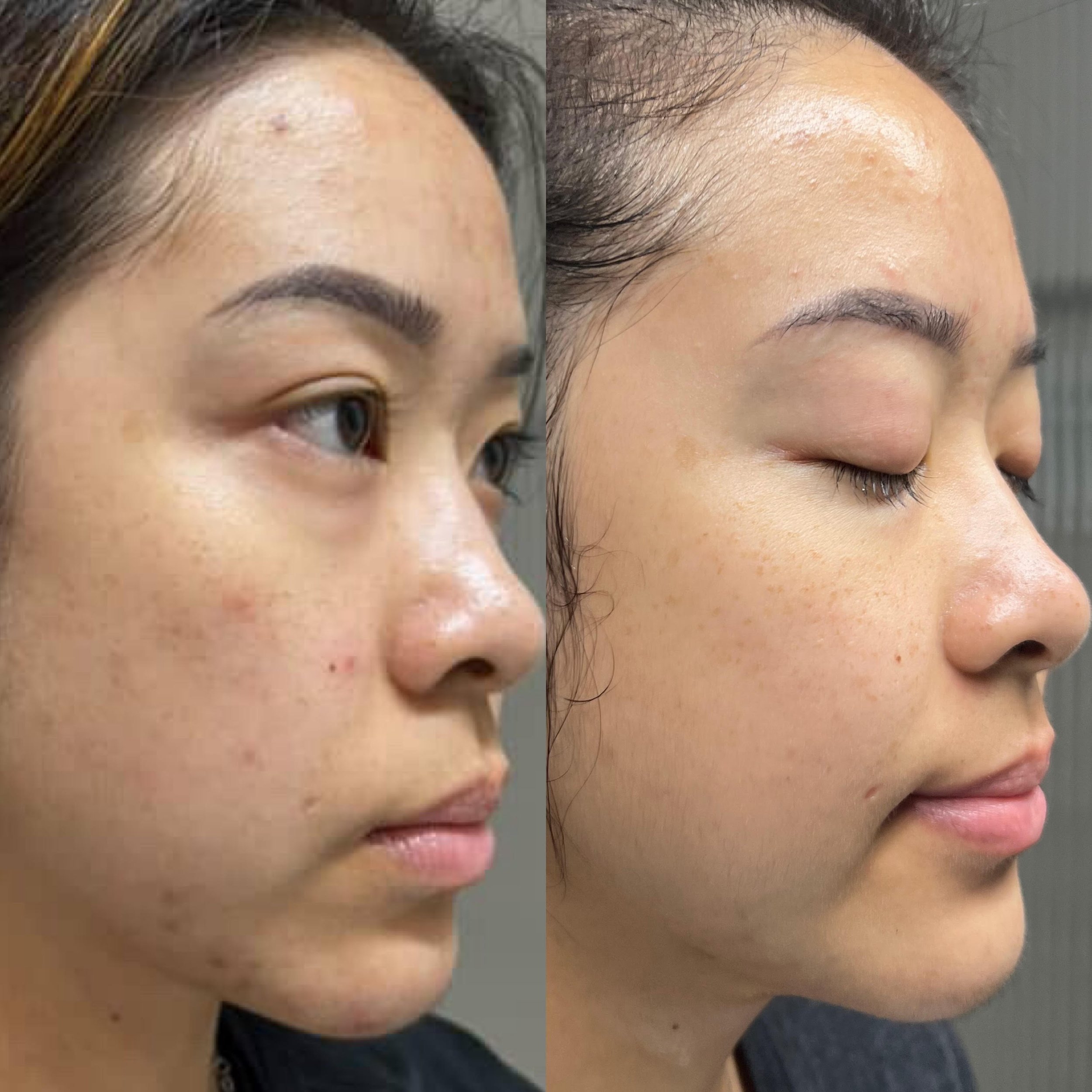 cheyenne cheek after one month.jpg
