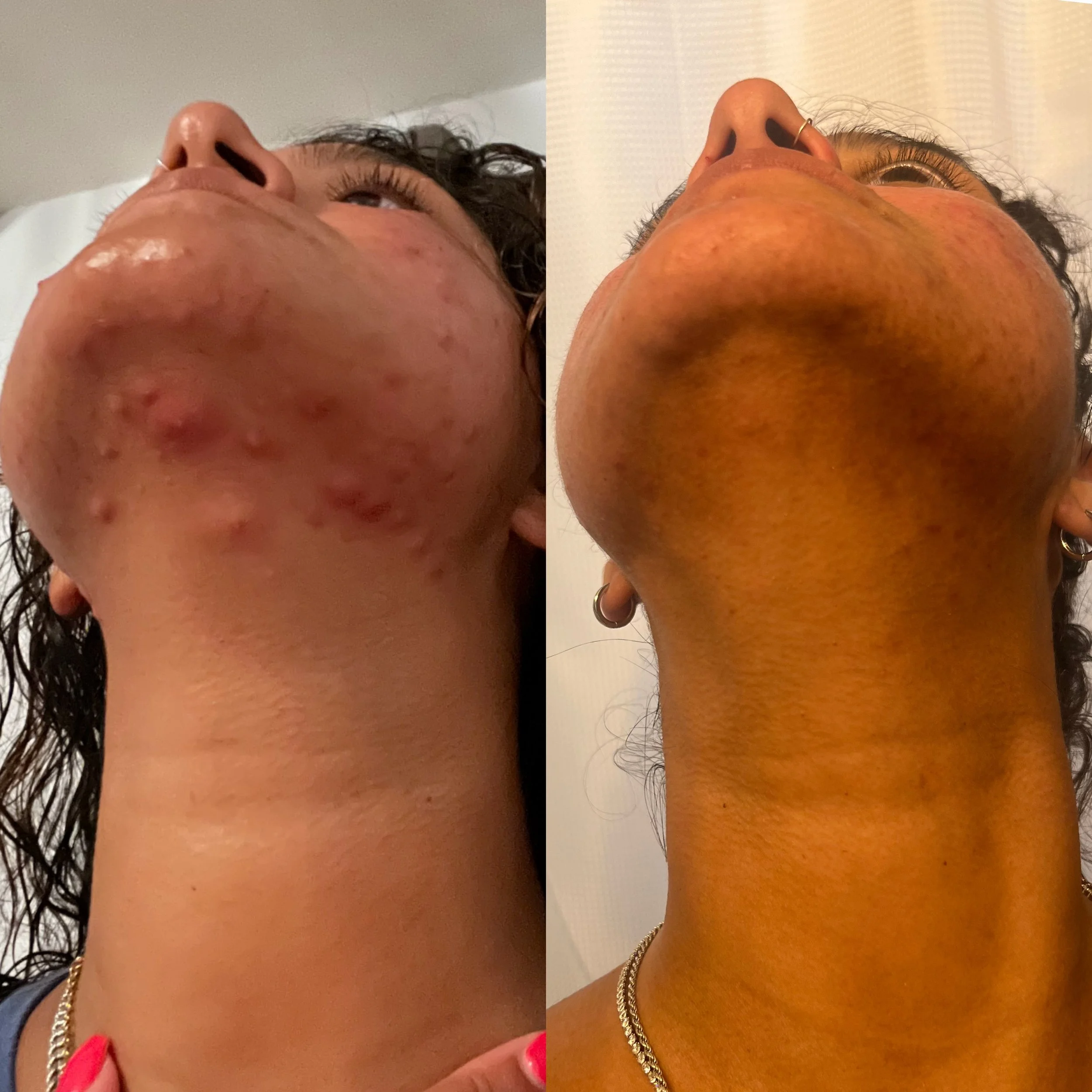 asha wilkinson neck 1 year apart.jpeg