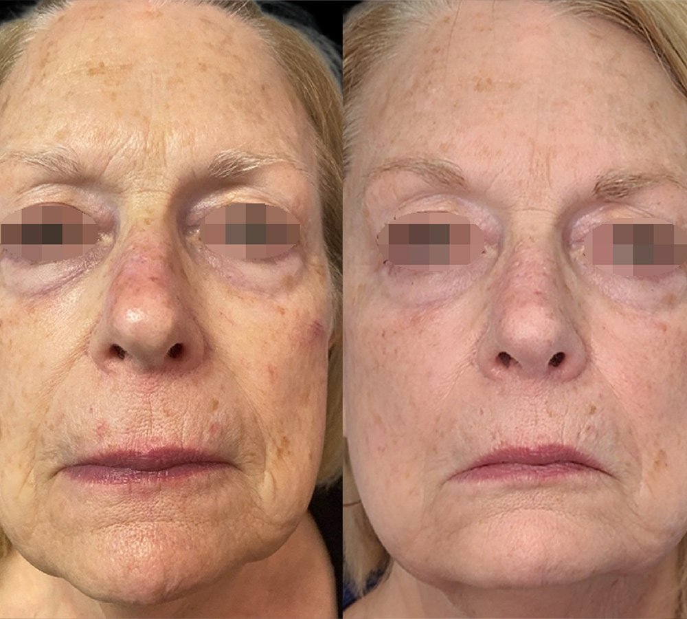  Before &amp; After 2 TXS Treatments 
