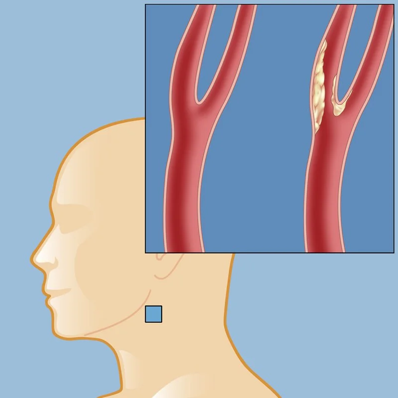 Carotid and vertebral disease