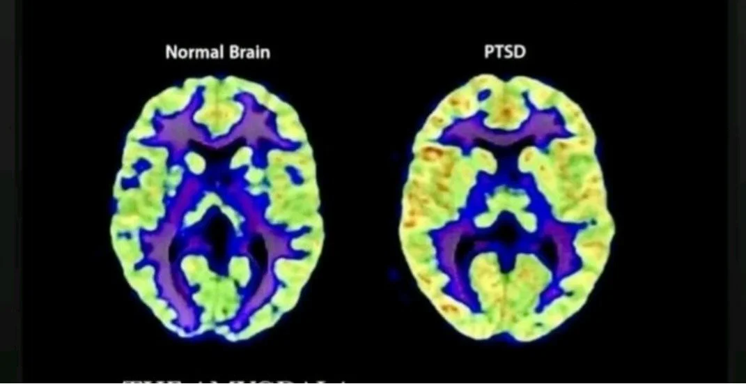Post Traumatic Stress Disorder (PTSD) and the Brain
