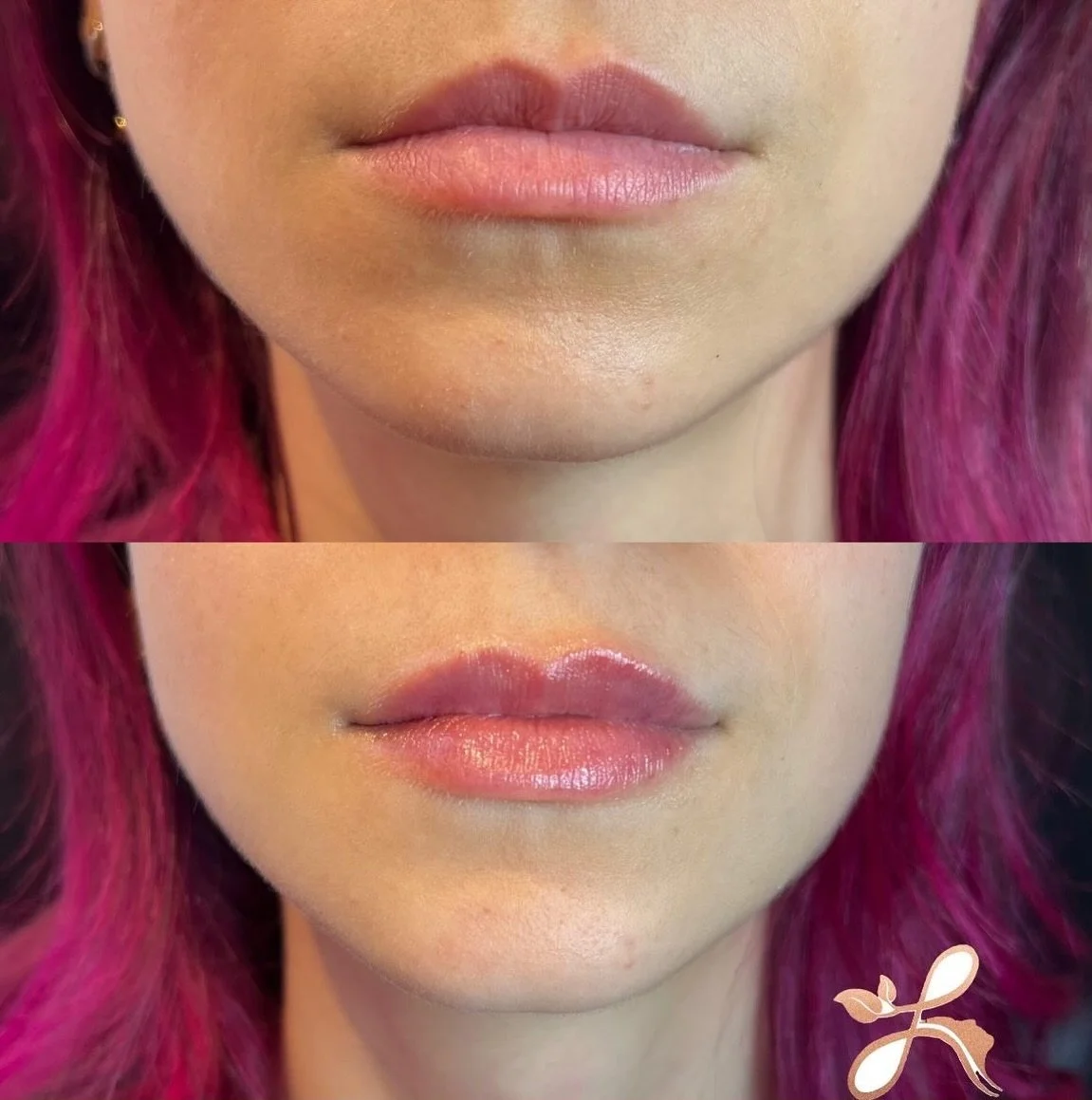 The prettiest mini lip plump! 

Pictures taking immediately after treatment.

Book a complimentary consult 

Lush Aesthetics
10 Elm St
Danvers MA
Christina (Bertoli) Mojica NP
www.lushaestheticsmedspa.com
📕 link in bio

#cosmeticinjetor #danversma #