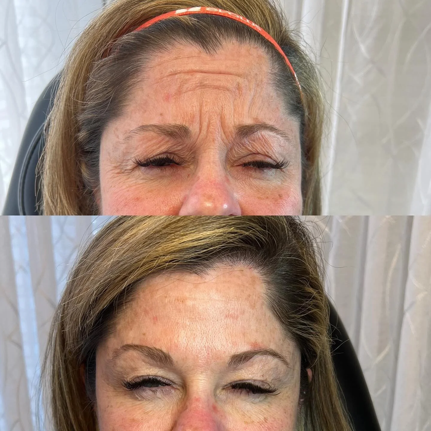 This full face tox &ldquo;left no crumbs&rdquo; as the kids say,is that what they are saying?!?😂😂 Did I do it right? 

Book a complimentary consult 

Lush Aesthetics
10 Elm St
Danvers MA
Christina (Bertoli) Mojica NP
www.lushaestheticsmedspa.com
📕