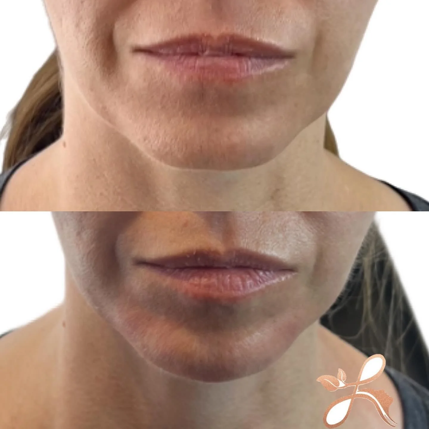 Request: a subtle age appropriate lower face refresh. 

We did some jawline, chin, pre-jowl and shadowing. 

Come see me for a complimentary consult!

Lush Aesthetics
10 Elm St
Danvers MA
Christina (Bertoli) Mojica NP
www.lushaestheticsmedspa.com
📕 