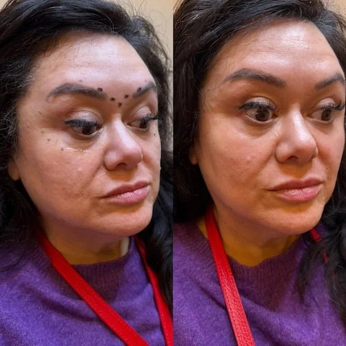 before-and-after-botox.JPG