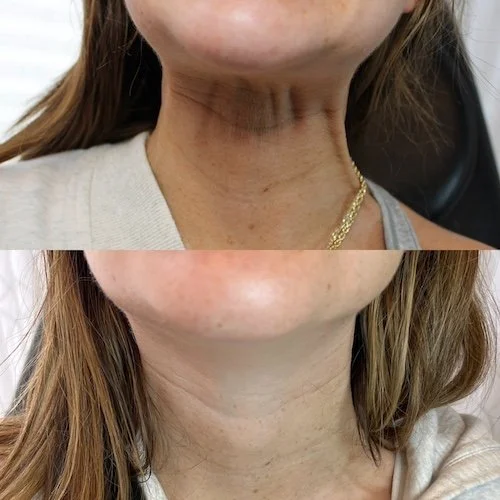 before-and-after-neck-injectables-med-spa.JPG
