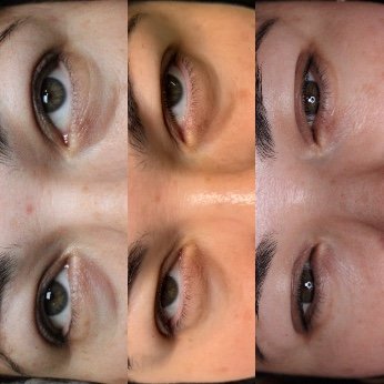 eye-lift-depuff-med-spa-services.JPG