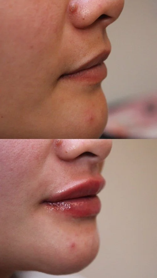 woman-side-profile-before-after-results-lip-injections.JPG