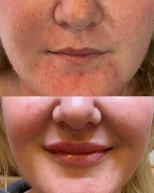 woman's-face-lip-injections.JPG