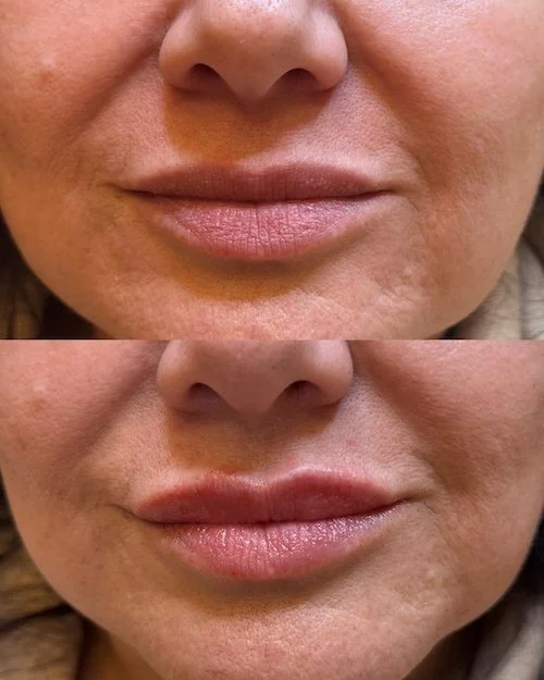 woman's-lips-before-after-lip-injection-results.JPG