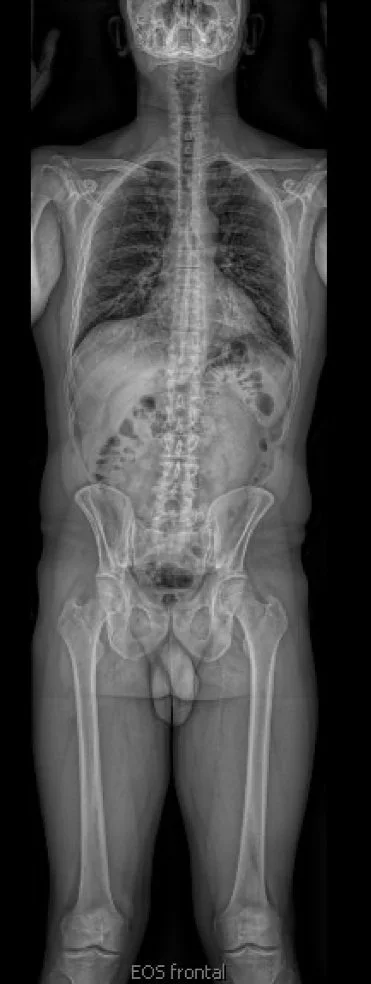 Spine scoli lateral.jpg